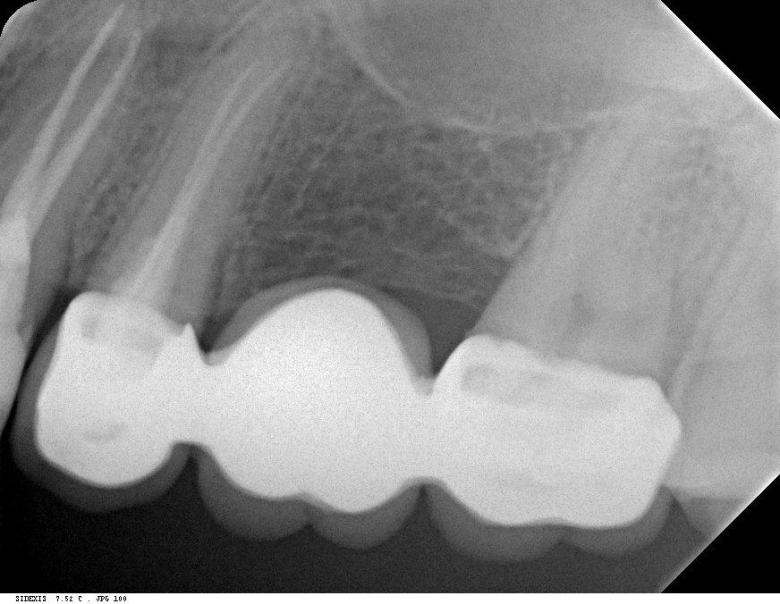 Röntgenbild von einem wurzelgefüllten Zahn
