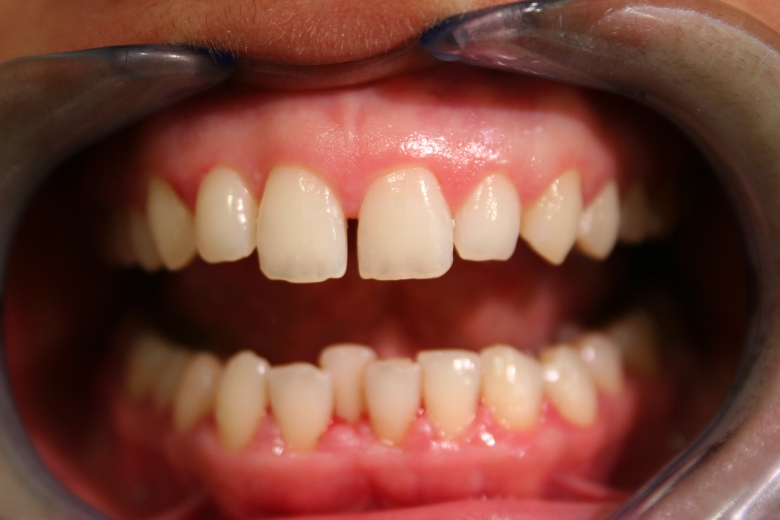 Obere Zahnlücke (Diastema) 